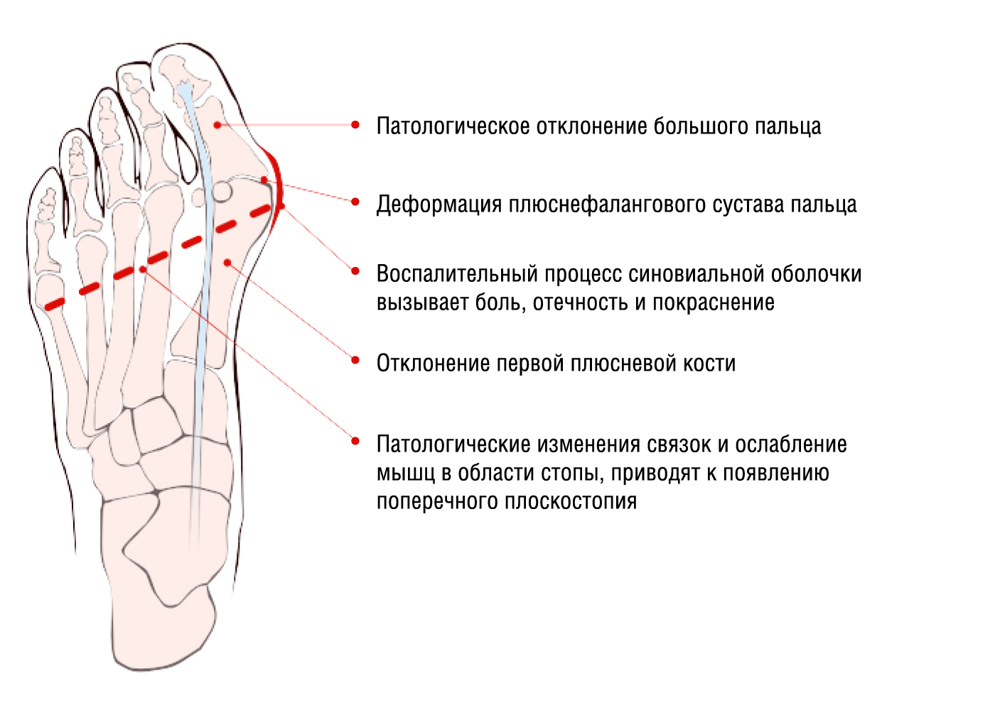 Ортопедическая шина для лечения косточек на ногах